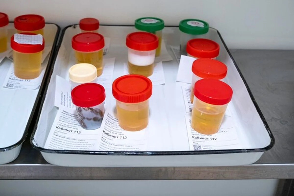 Sterylne pojemniki z moczem na tle ludzi poddających się badaniom diagnostycznym