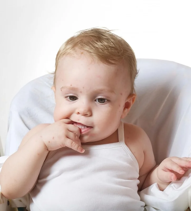 Roczne dziecko zarażone ospą wietrzną