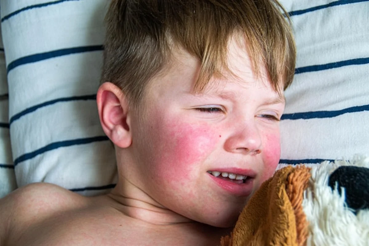 Wysypka na ciele dziecka - objawy mononukleozy