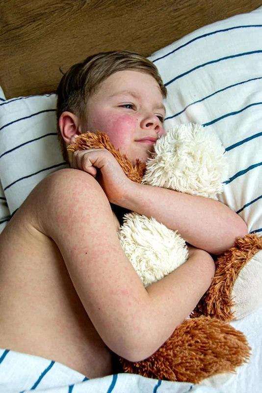 Wysypka na ciele dziecka - objaw choroby wirusowej odry lub alergii