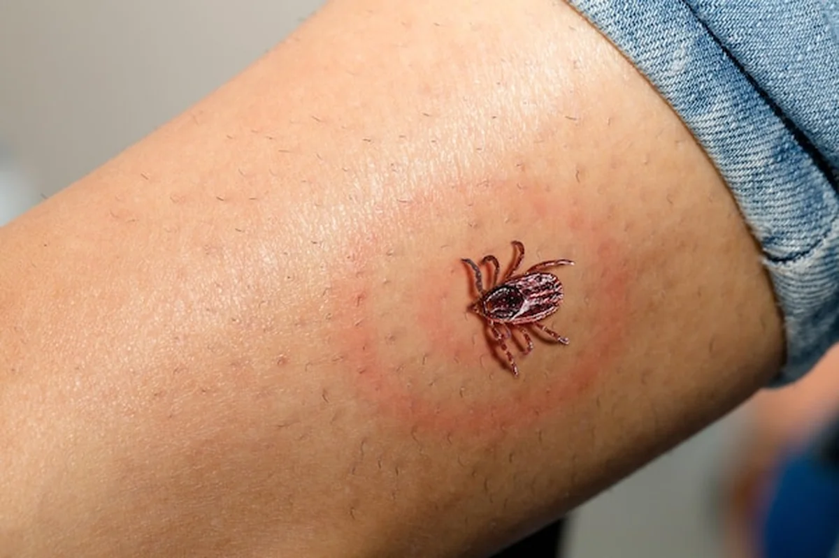 Podrażnienie na nodze po ugryzieniu przez kleszcza